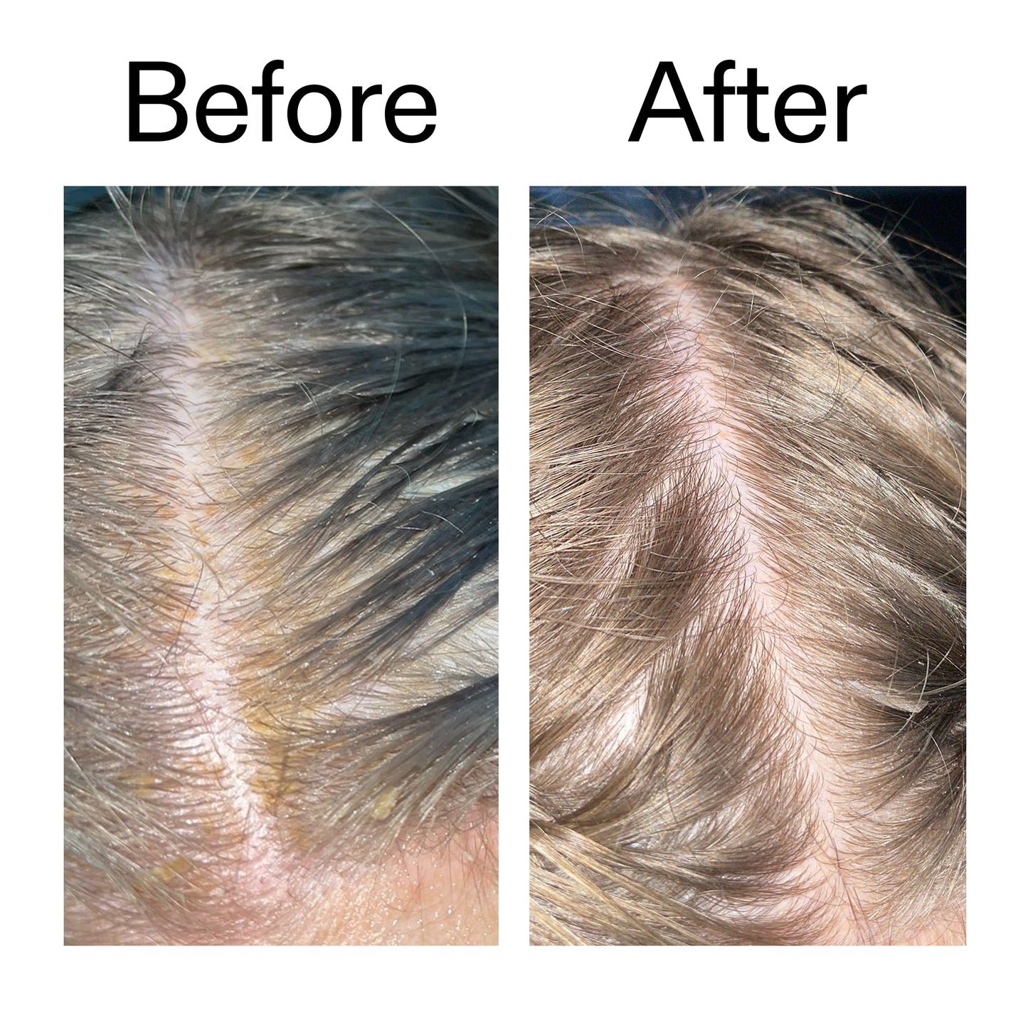 salicylic-acid-exfoliating-scalp-treatment-i5 Salicylic_Acid_Exfoliating_Scalp_Treatment_Before_After_2000x2000_e572a30f-057c-4a48-823b-1c09dc97f8d0.jpg