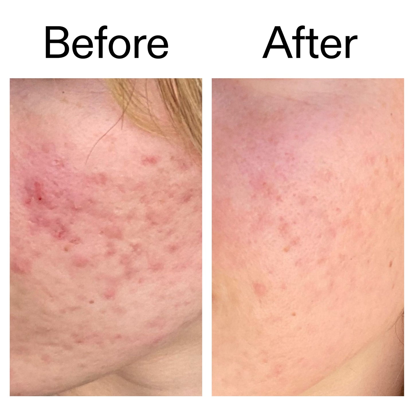 10-azelaic-acid-serum-for-redness-relief-c8 Azealic_Acid_Serum_B_A_Ppage_2000_x_2000.jpg