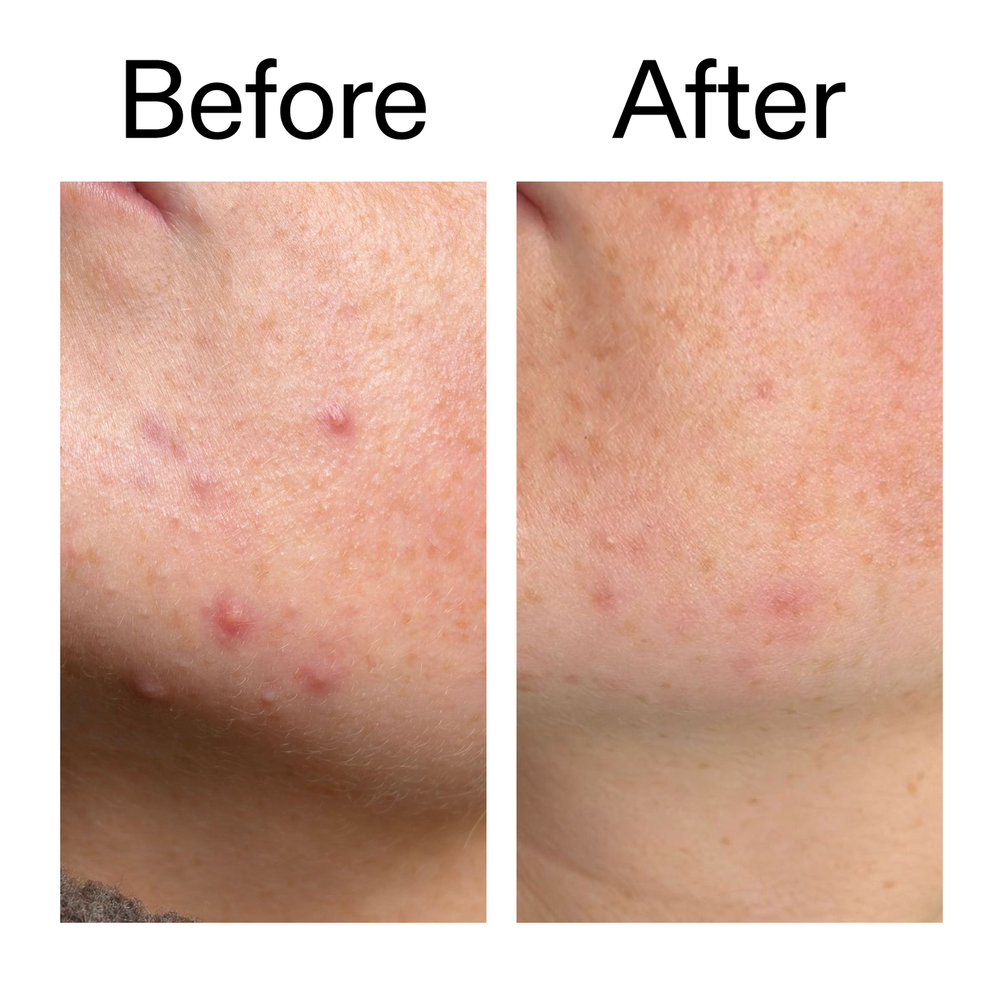 10-azelaic-acid-serum-for-redness-relief-c8 B_A_1_PPAGE.png