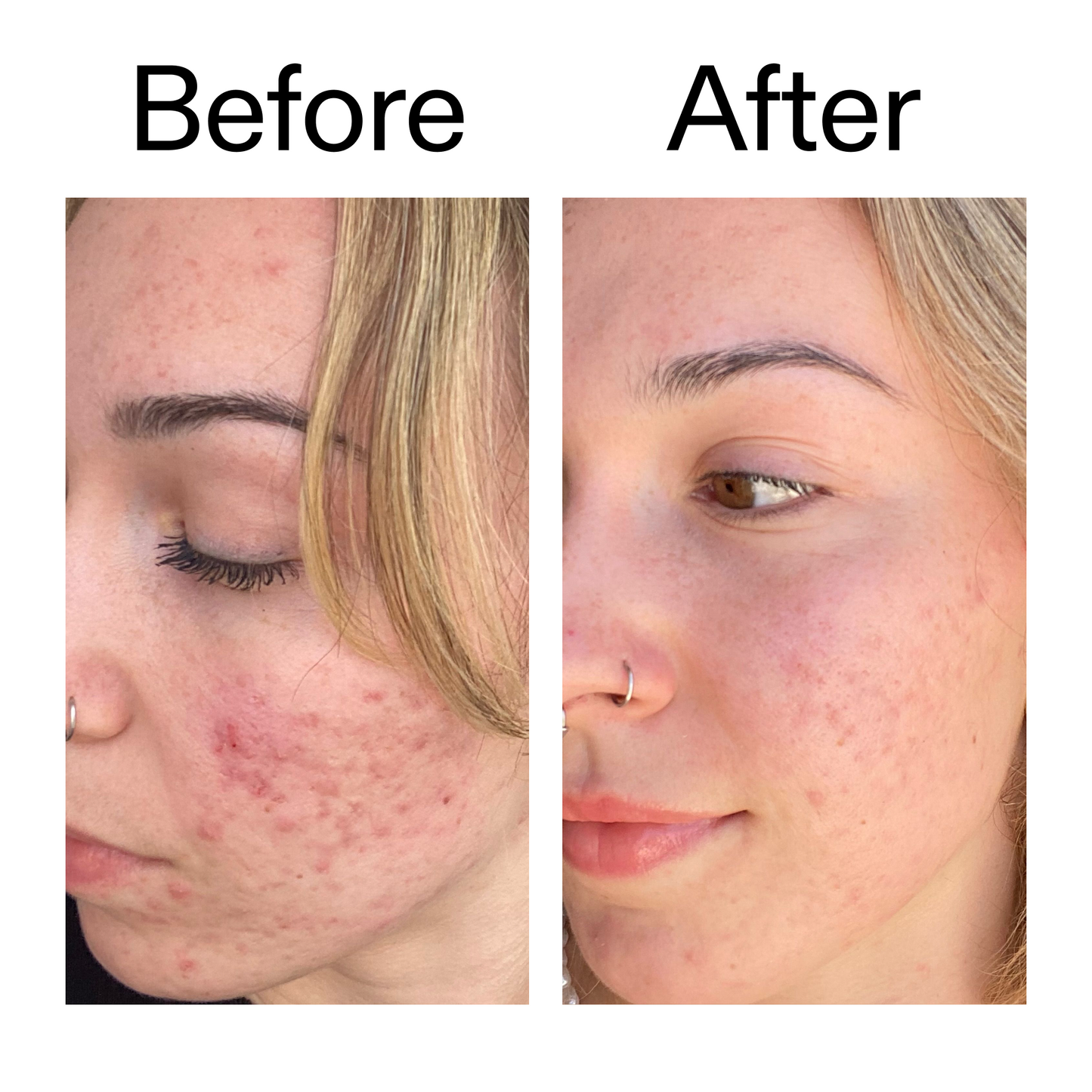10-azelaic-acid-serum-for-redness-relief-c8 B_A_2_PPAGE.png