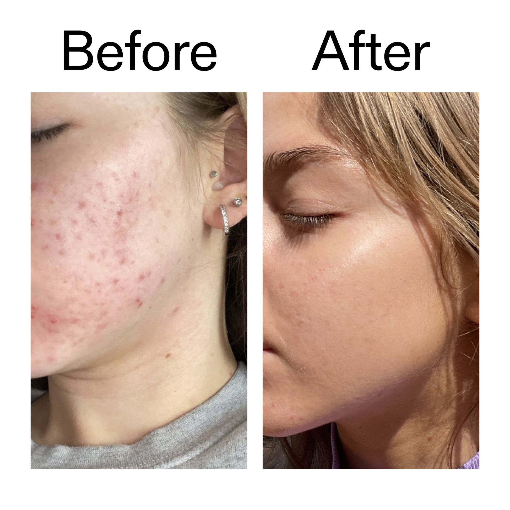 beta-hydroxy-acid-bha-serum-l7 Beta_Hydroxy_Acid_Serum_Before_After_2000x2000_96fda3e5-938d-49ef-bcf2-a0fa6ece4e2c.jpg
