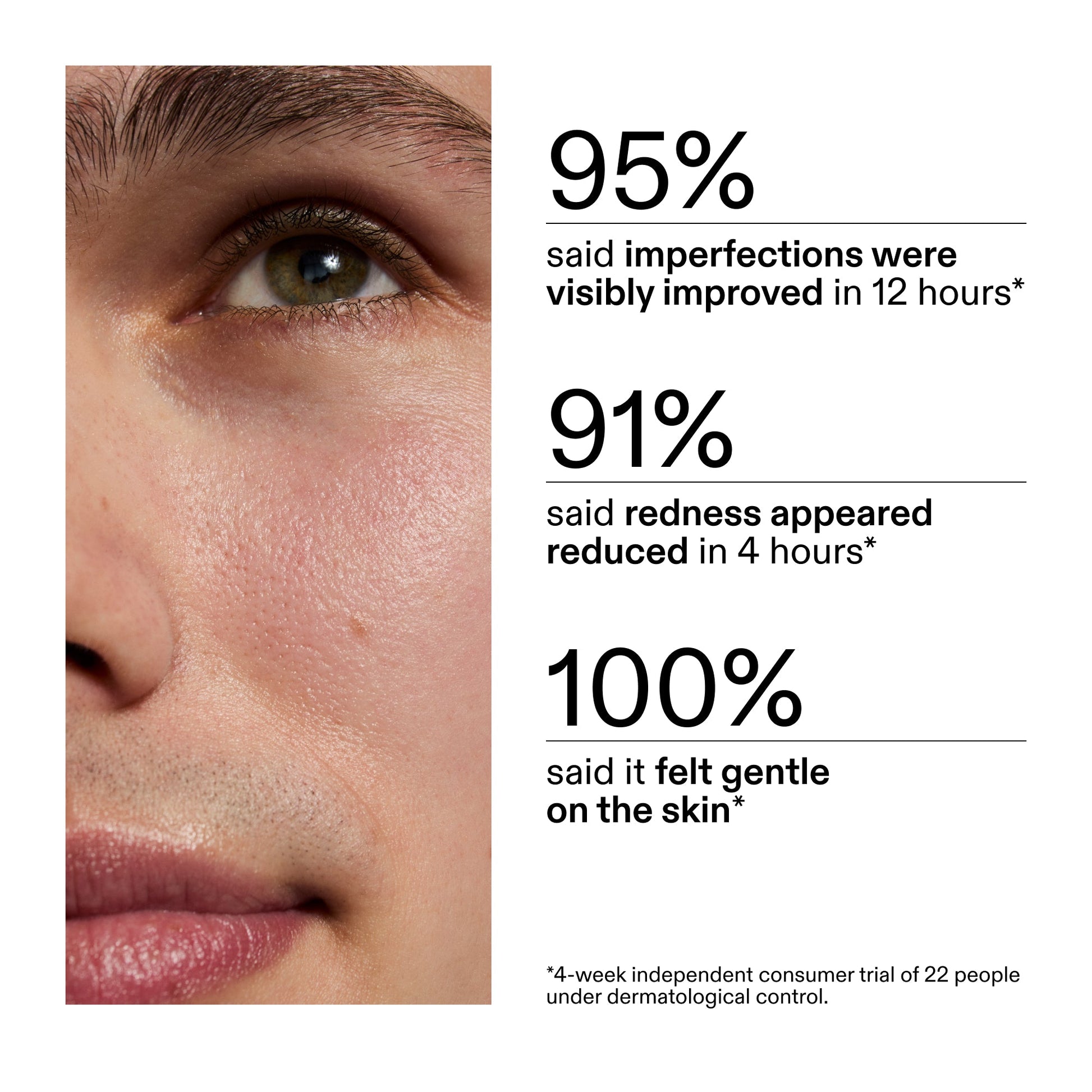 succinic-acid-acne-treatment-q0 CA_Succinic_Acid_Treatment_key_Claims_2000x2000_db91b0f1-7f29-4bfe-bb16-63a47f500960.jpg