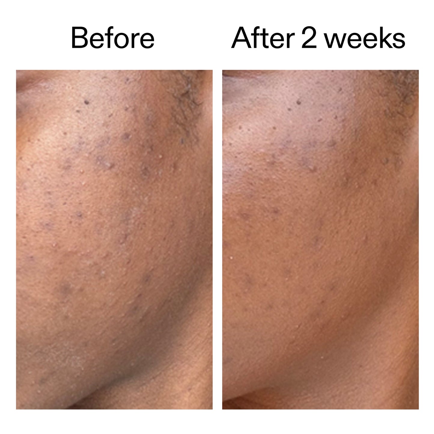 360-acne-clearing-duo-m8 DIOICB_A2000x2000.jpg