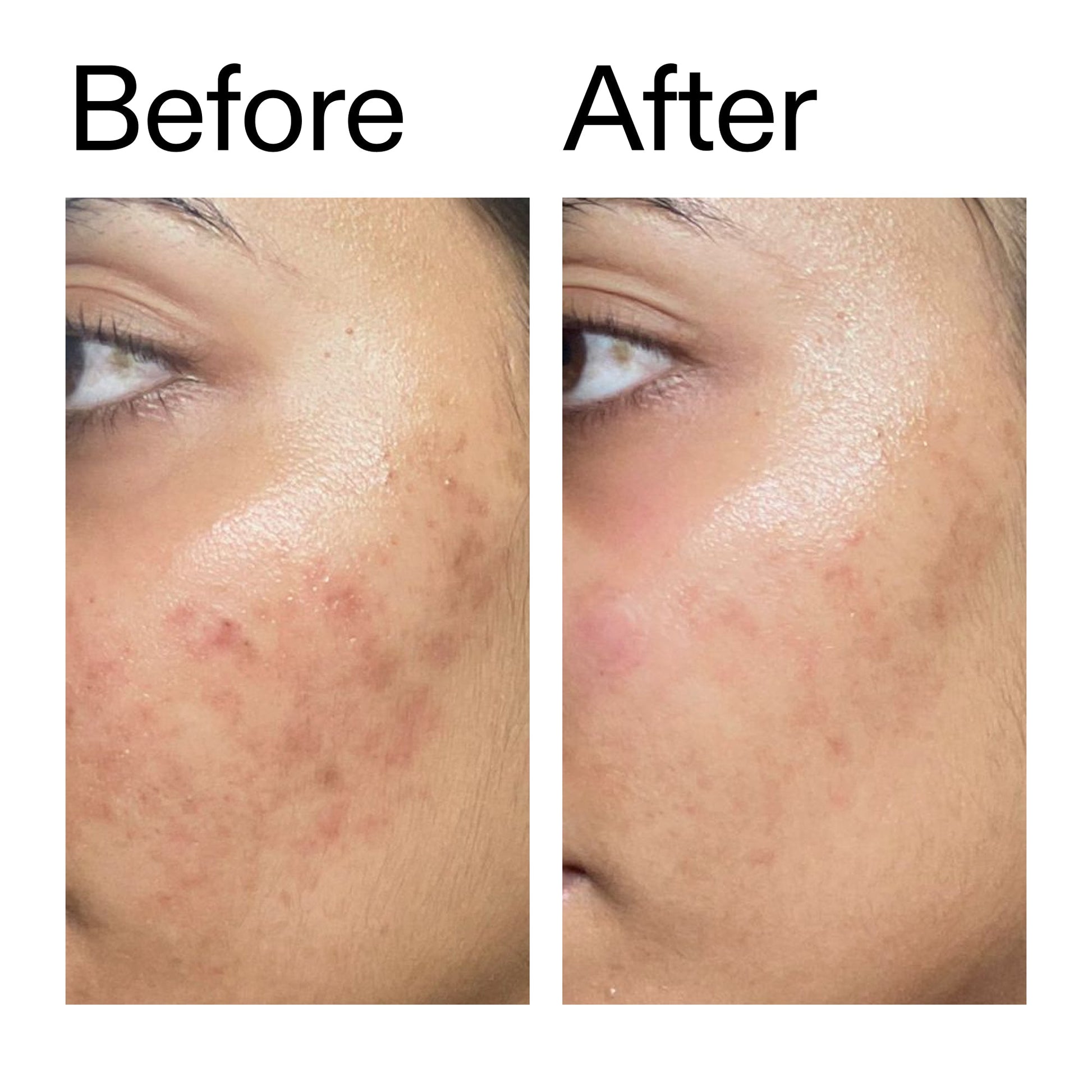 ectoin-hydro-barrier-serum-c8 Ectoin_Hydro-barrier_Serum__Before_After_2000x2000_34261920-d004-48d0-9c7b-8e1c15971bfd.jpg