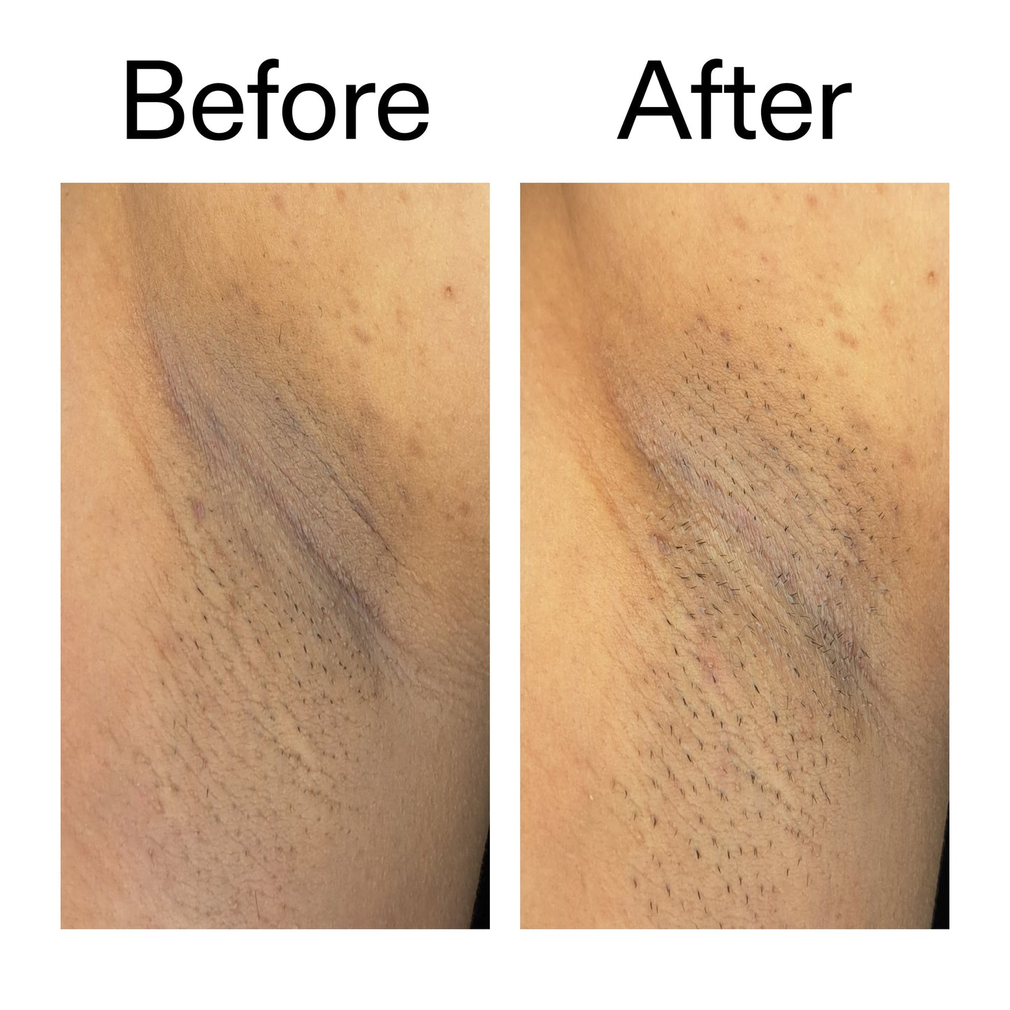 glycolic-acid-exfoliating-body-stick-z5 Glycolic_Acid_Exfoliating_Body_Stick_Before_After_V3_2000x2000_ea919cd9-1439-4a46-82a0-76200eb5bb42.jpg