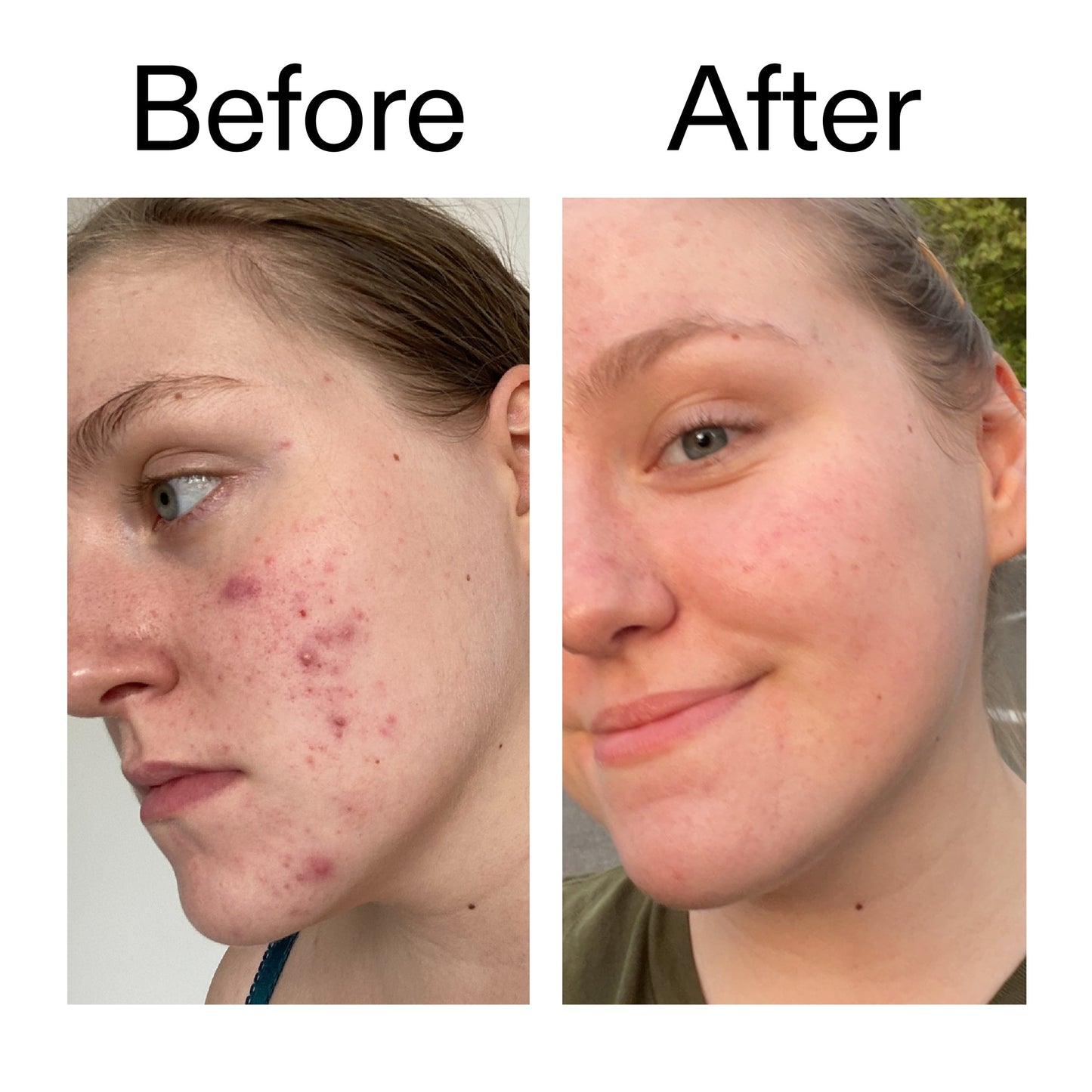 glycolic-acid-toner-m8 Glycolic_Acid_Toner_Before_After_2000x2000_49f0b9f7-e71b-4b2e-a8f8-2ea4b73247bb.jpg
