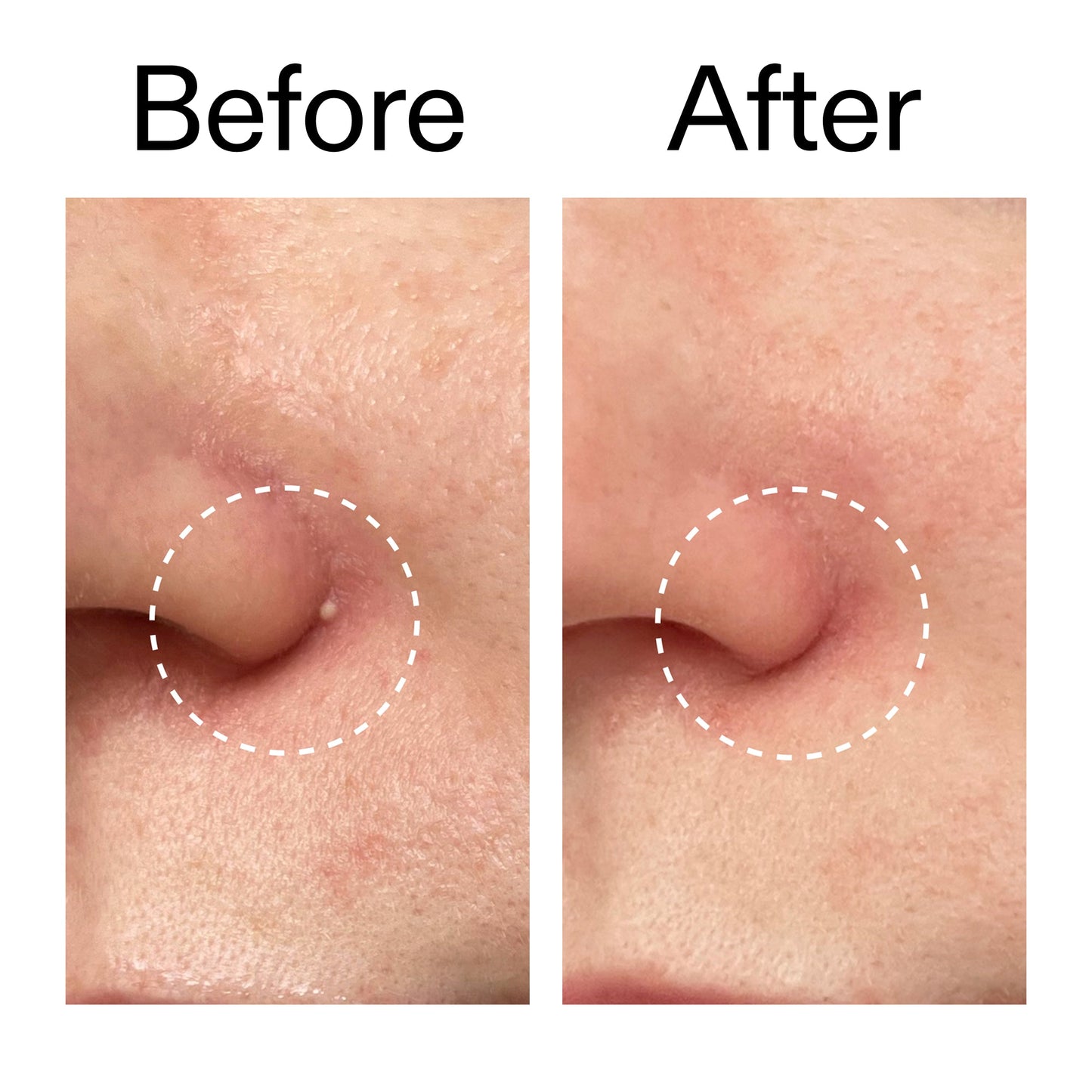 hydrocolloid-invisible-pimple-patches-pack-of-22-o9 Hydrocolloid_Invisible_Pimple_Patches_Before_After_2000x2000_b02aa37b-c78a-4682-91de-9135af5bb7df.jpg