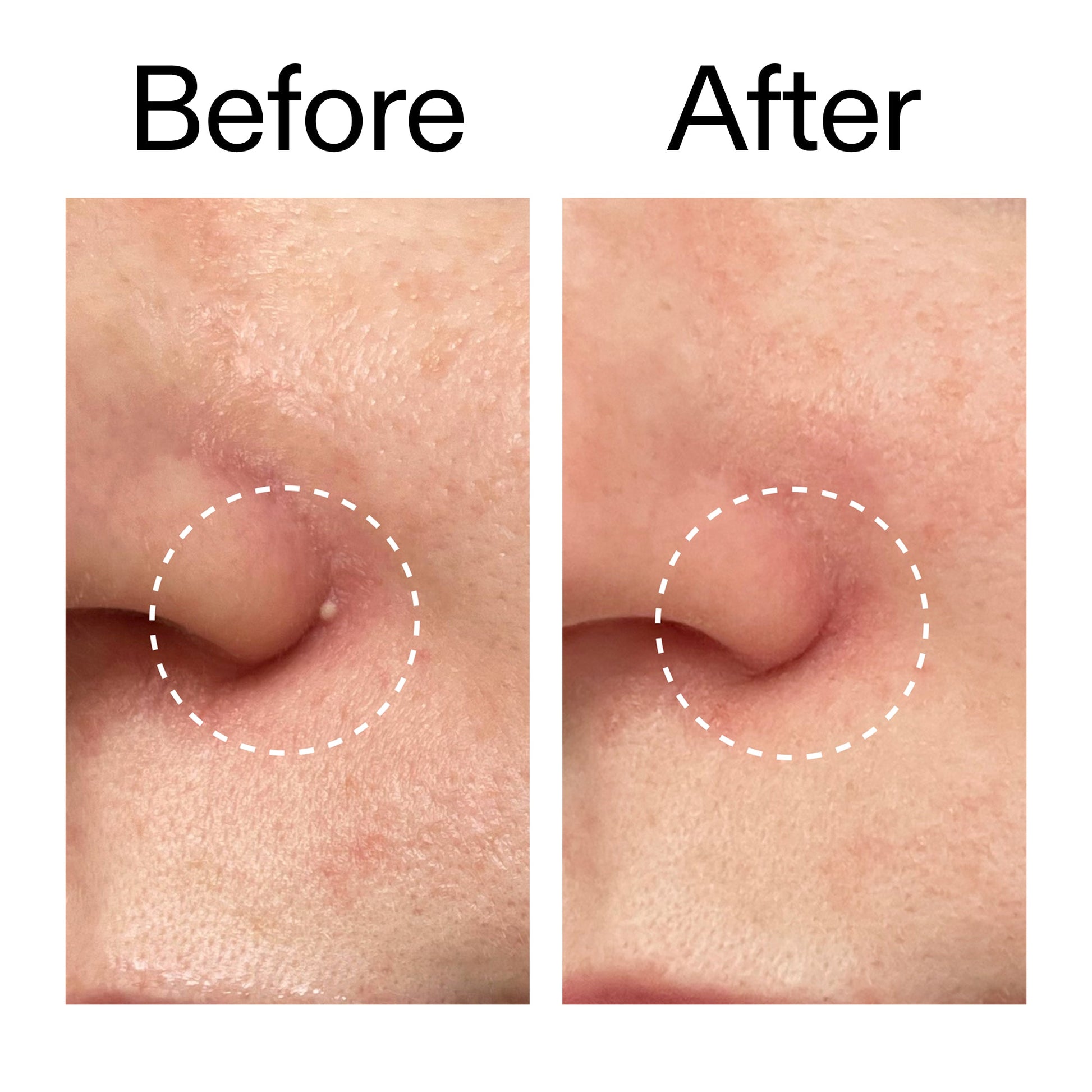 hydrocolloid-invisible-pimple-patches-pack-of-22-o9 Hydrocolloid_Invisible_Pimple_Patches_Before_After_2000x2000_b02aa37b-c78a-4682-91de-9135af5bb7df.jpg