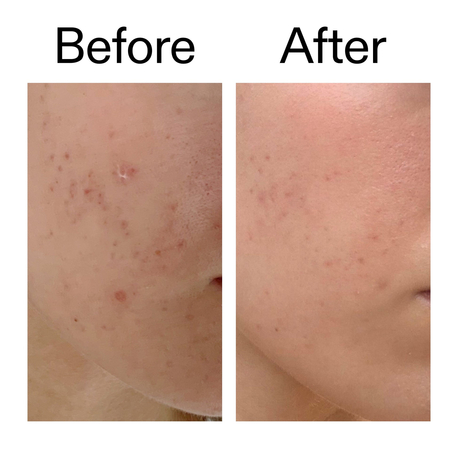 mandelic-acid-treatment-z5 Mandelic_Acid_Treatment_Before_After_2000x2000_4885ac6e-c5d7-4279-a72a-1417af7dce35.jpg