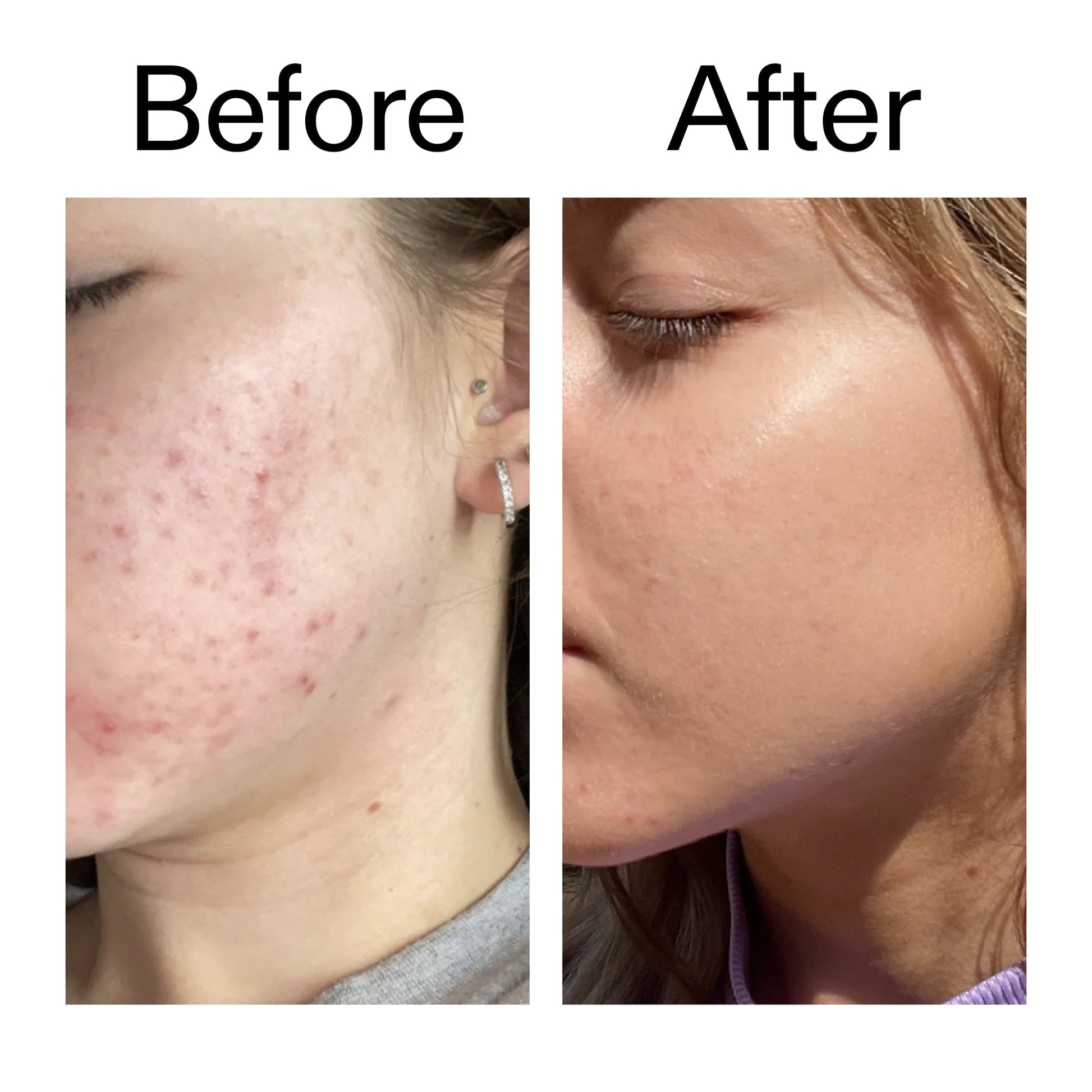 10-niacinamide-serum-j4 Niacinamide_Serum_Before_After_2000x2000_bde32455-9e7d-448e-b053-bef41504f0a9.jpg