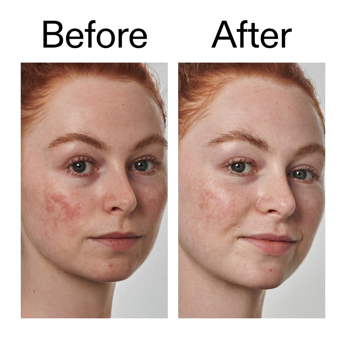 10-azelaic-acid-serum-for-redness-relief-c8 Redness_Relief_Serum_Before_After_2000x2000_3334dc9a-cce9-4e00-8aec-7ad89ca051f2.jpg