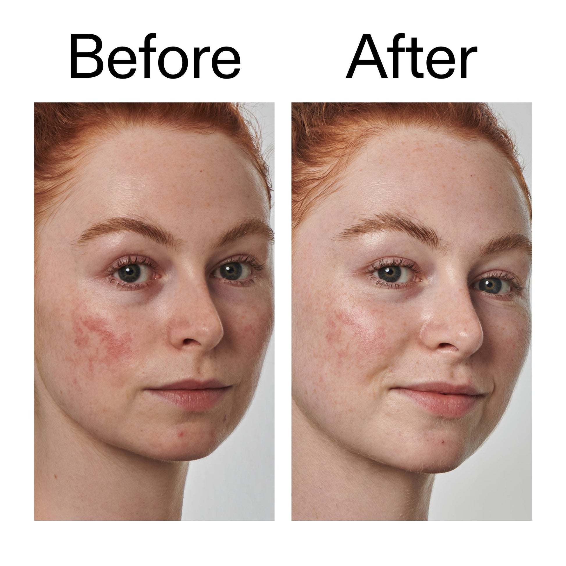 10-azelaic-acid-serum-for-redness-relief-c8 Redness_Relief_Serum_Before_After_2000x2000_3334dc9a-cce9-4e00-8aec-7ad89ca051f2.jpg
