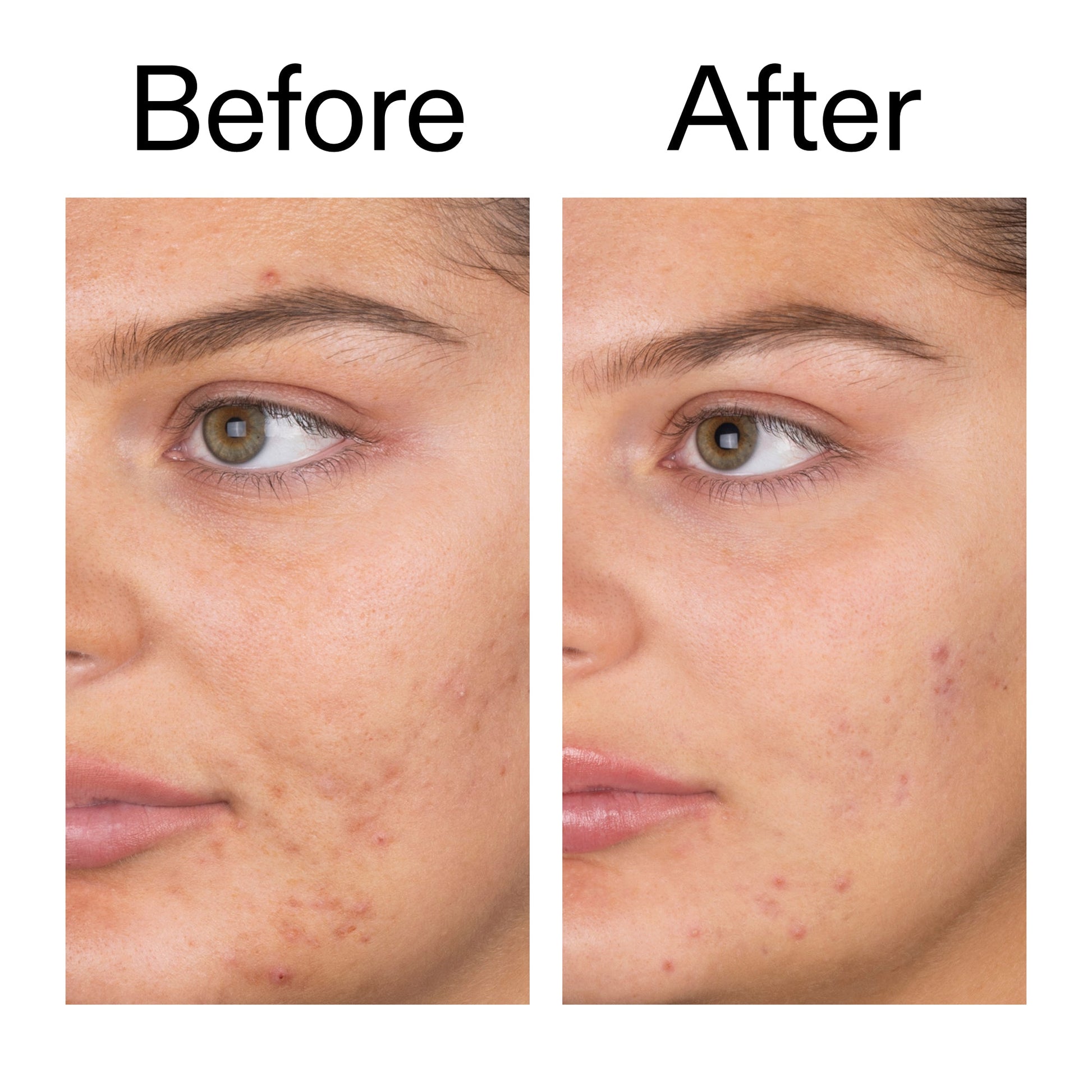 salicylic-acid-cleanser-duo-p8 Salicylic_Acid_Cleanser_-_150ml_Before_After_2000x2000_e7230494-853f-4b07-82b1-27669104c995.jpg