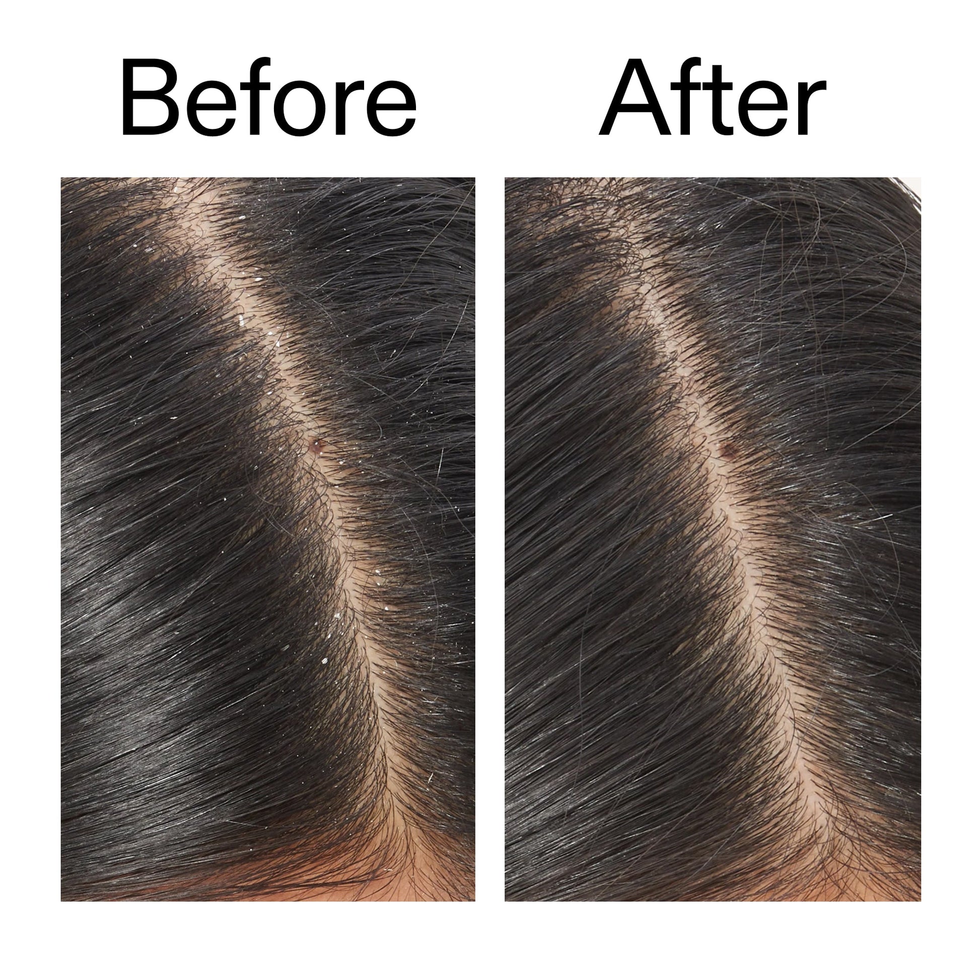 salicylic-acid-exfoliating-scalp-treatment-i5 Salicylic_Acid_Exfoliating_Scalp_Treatment_Before_After_V2_2000x2000_02bd61ad-42bf-490b-b3e3-7e04b2e8a673.jpg