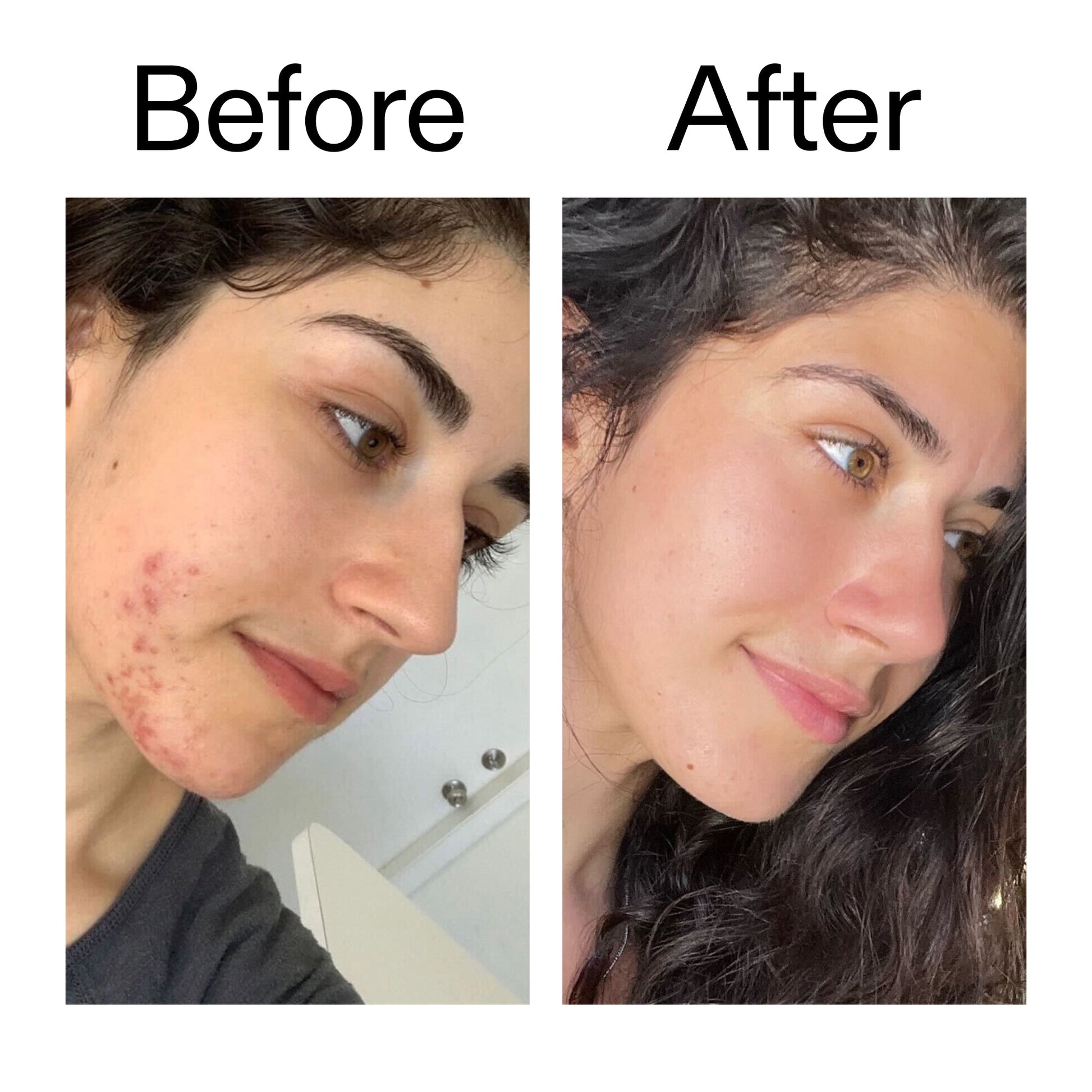 succinic-acid-acne-treatment-q0 Succinic_Acid_Treatment_Before_After_2000x2000_6a5f0054-2f58-4433-9314-0dc72c9bdd3b.jpg