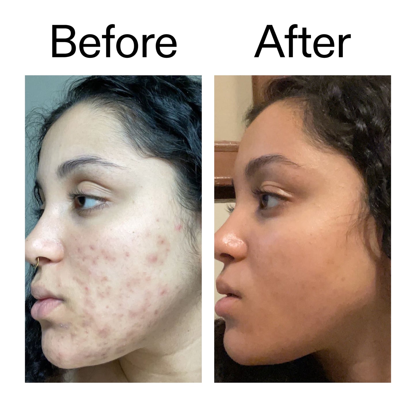 tranexamic-acid-serum-h7 Tranexamic_Acid_Serum_Before_After_2000x2000_98ebc8be-77b0-4843-8a22-90790ebe918b.jpg